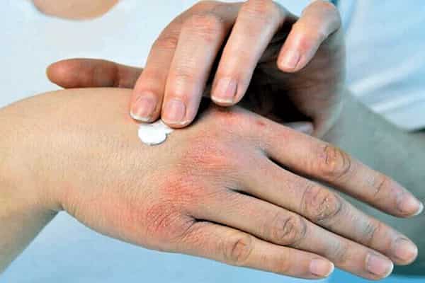 تصویر 4 از قیمت پماد ترک دست با کیفیت ارزان + خرید عمده